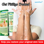 Vitiligo Cream White Spot Solution